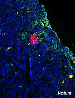 Nature | 华大Stereo-seq助力揭示黑色素瘤细胞的生长和转移机制