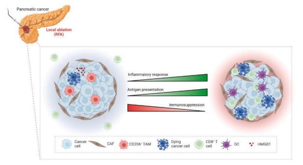 Local ablation disrupts immune evasion in pancreatic cancer