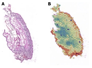Single-nucleus RNA sequencing and spatial transcriptomics reveal the mechanism by which Xiaozhiling injection treats internal hemorrhoids