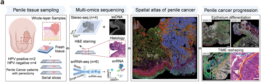 Single-Cell and Spatial Transcriptomic Profiling of Penile Squamous Cell Carcinoma Reveals Dynamics of Tumor Differentiation and Immune Microenvironment